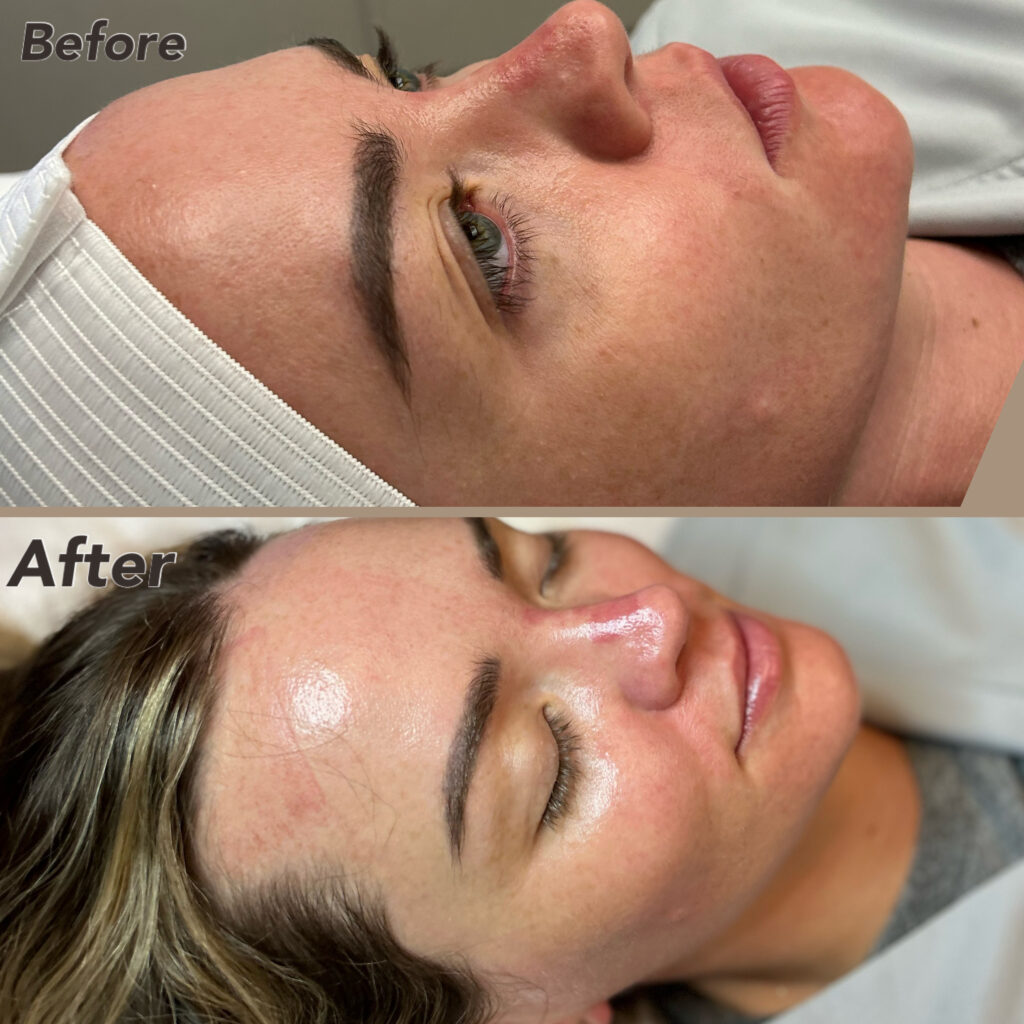 Hydrafacial results